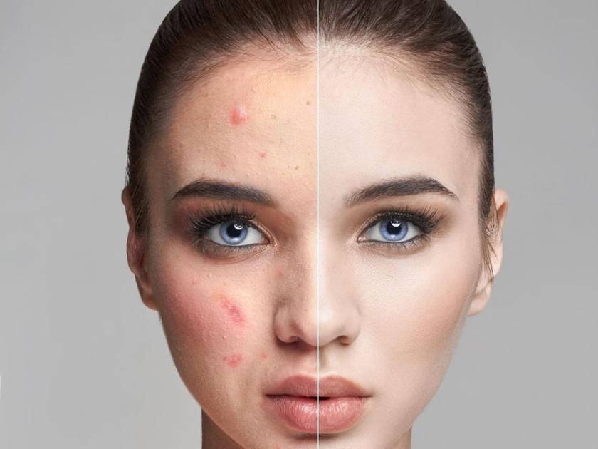 acne-scars-treatment-pragathinagar-hyderabad