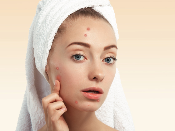 acne-treatment-near-pragathinagar-hyderabad