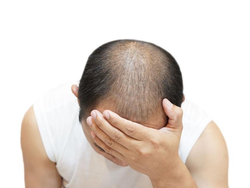 baldness-treatment-pragathinagar-hyderabad