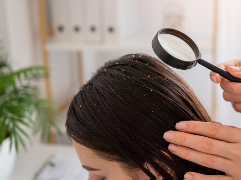 dandruff-treatment-pragathinagar-hyderabad