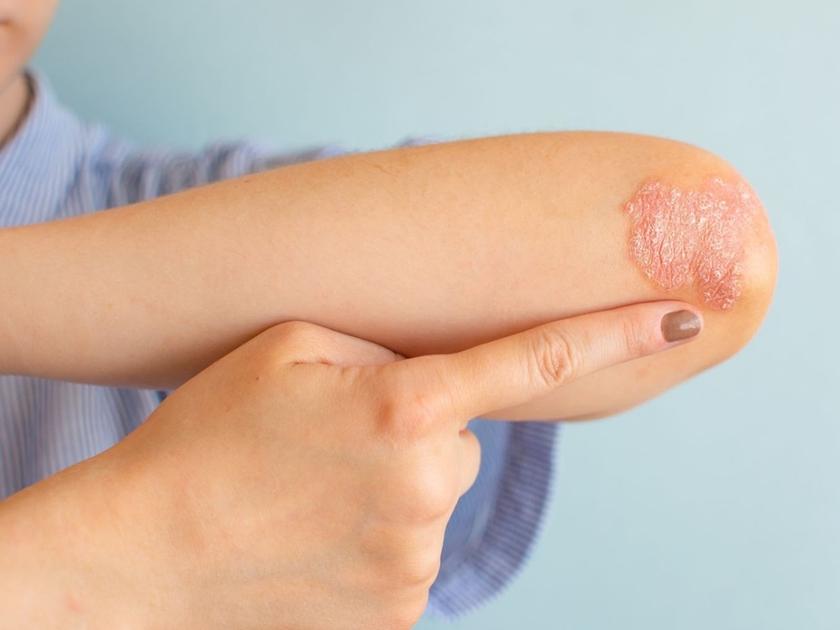 eczema-treatment-pragathinagar-hyderabad