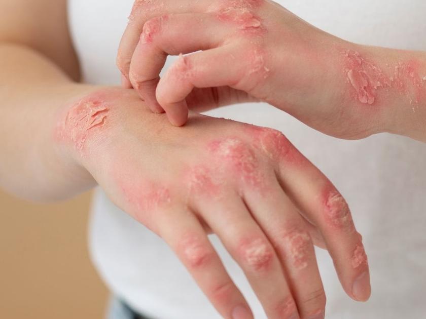 psoriasis-treatment-pragathinagar-hyderabad