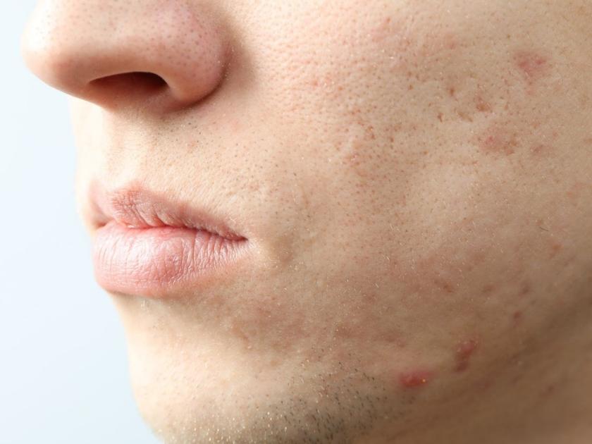 acne-treatment-near-pragathinagar-hyderabad